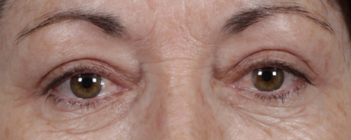 After Procedure