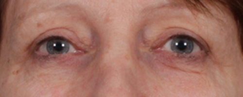 After Procedure