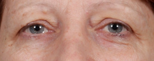 Before Procedure