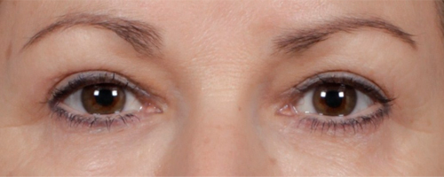 After Procedure