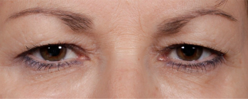 Before Procedure