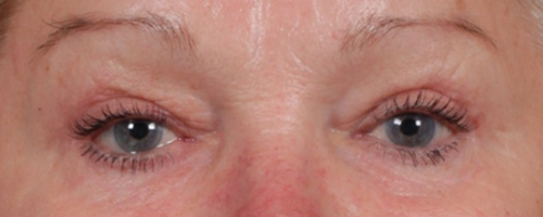 After Procedure