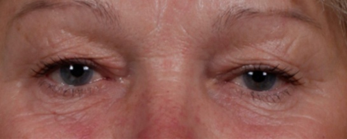 Before Procedure