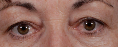 Before Procedure
