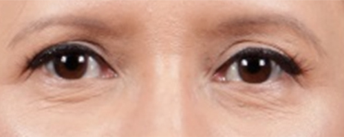 After Procedure