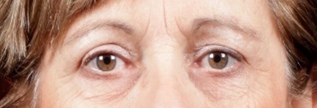 After Procedure