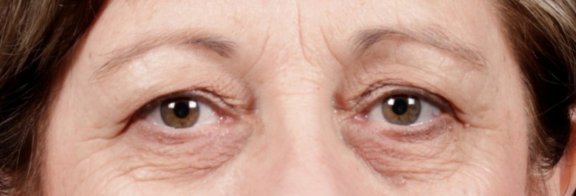 Before Procedure