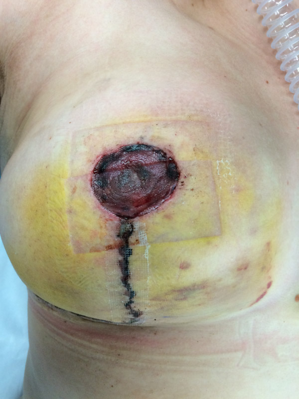 Nipple necrosis