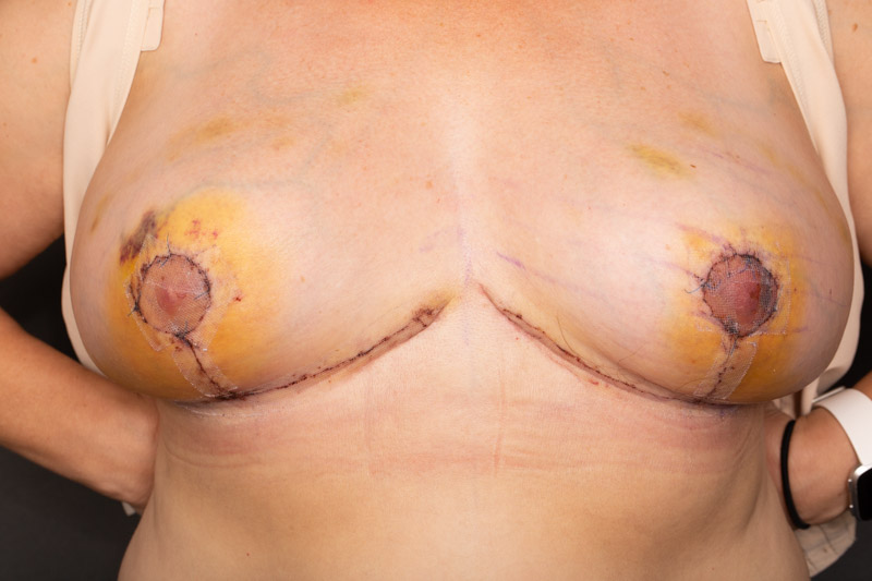 Left nipple a bit dicey