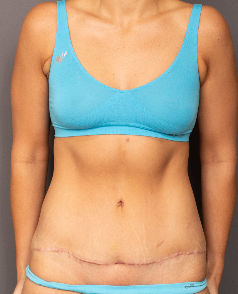 37yo Abdominoplasty After