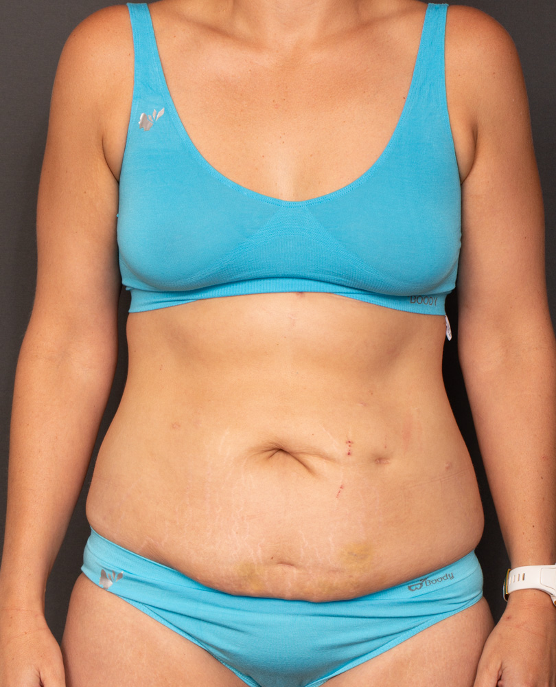 37yo Abdominoplasty Before