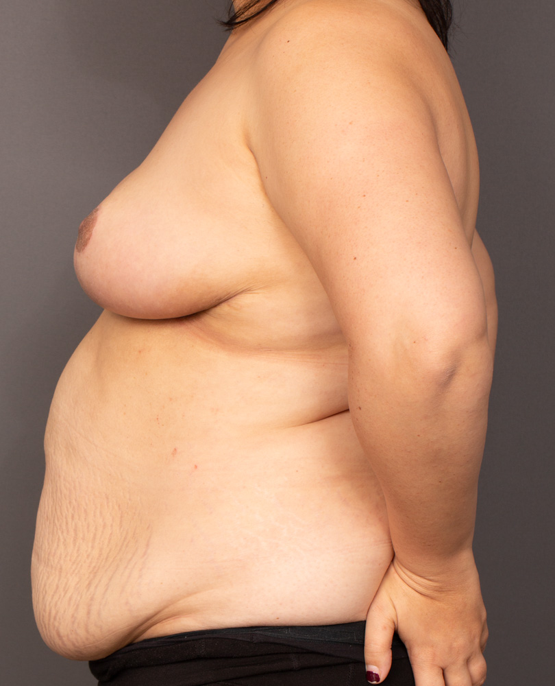 After Procedure