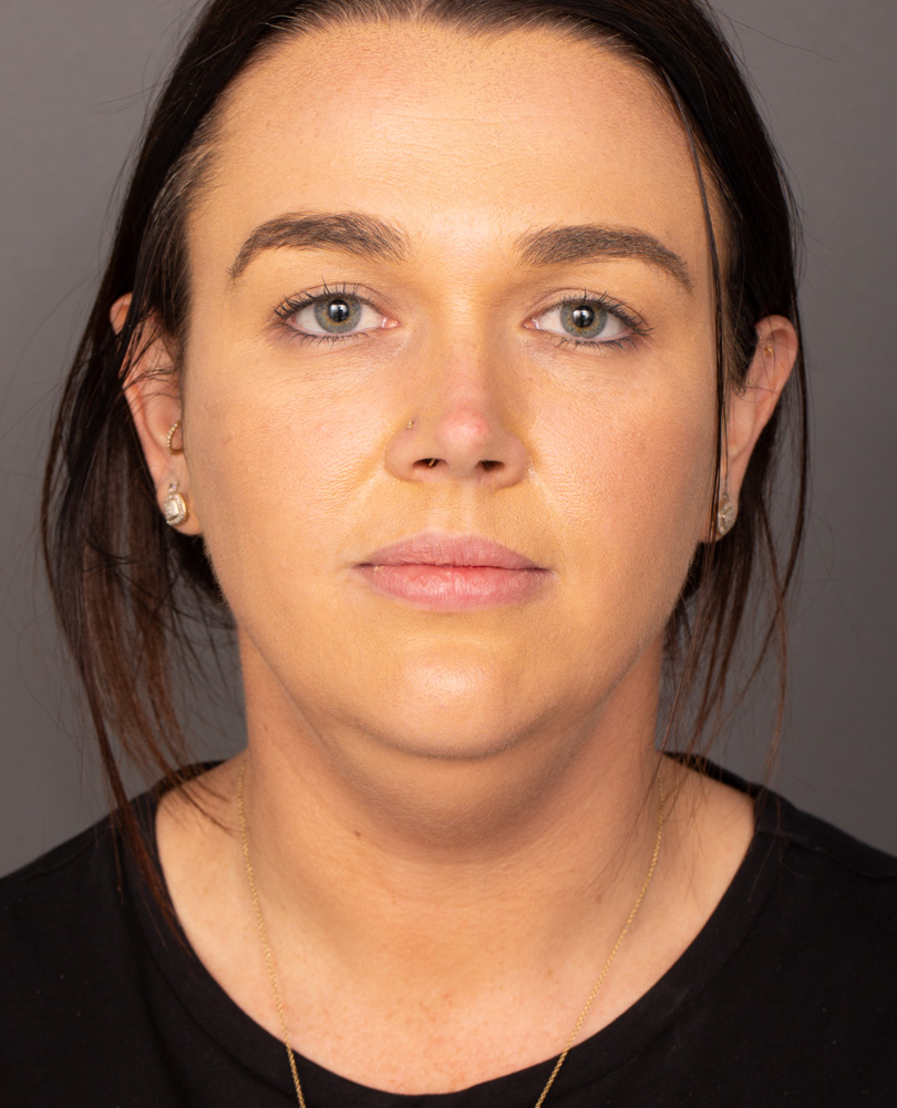 Before Procedure