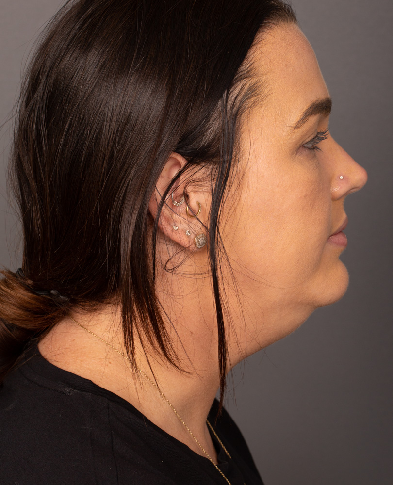 Before Procedure