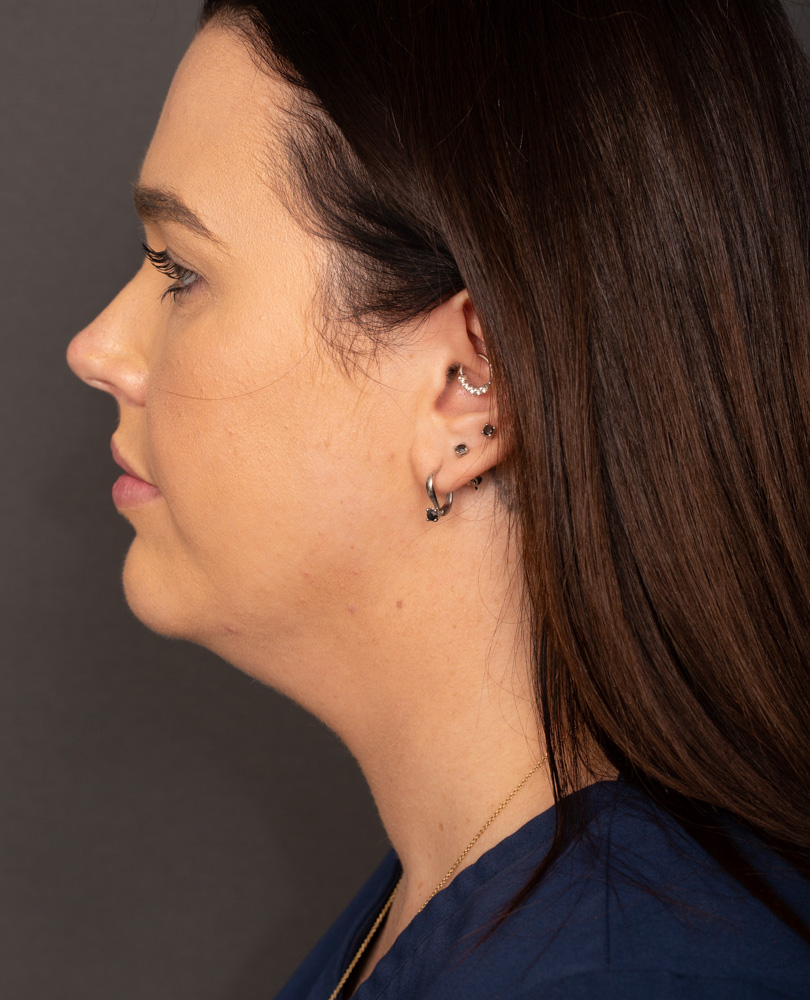 Before Procedure
