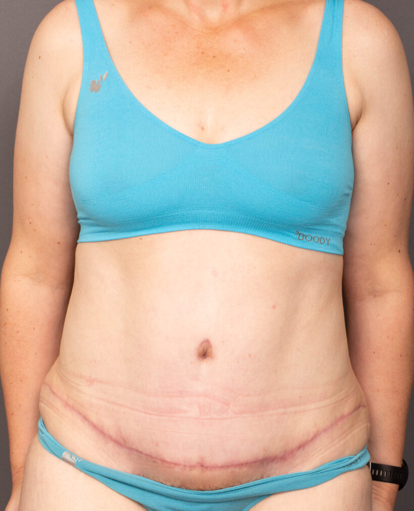 After Procedure