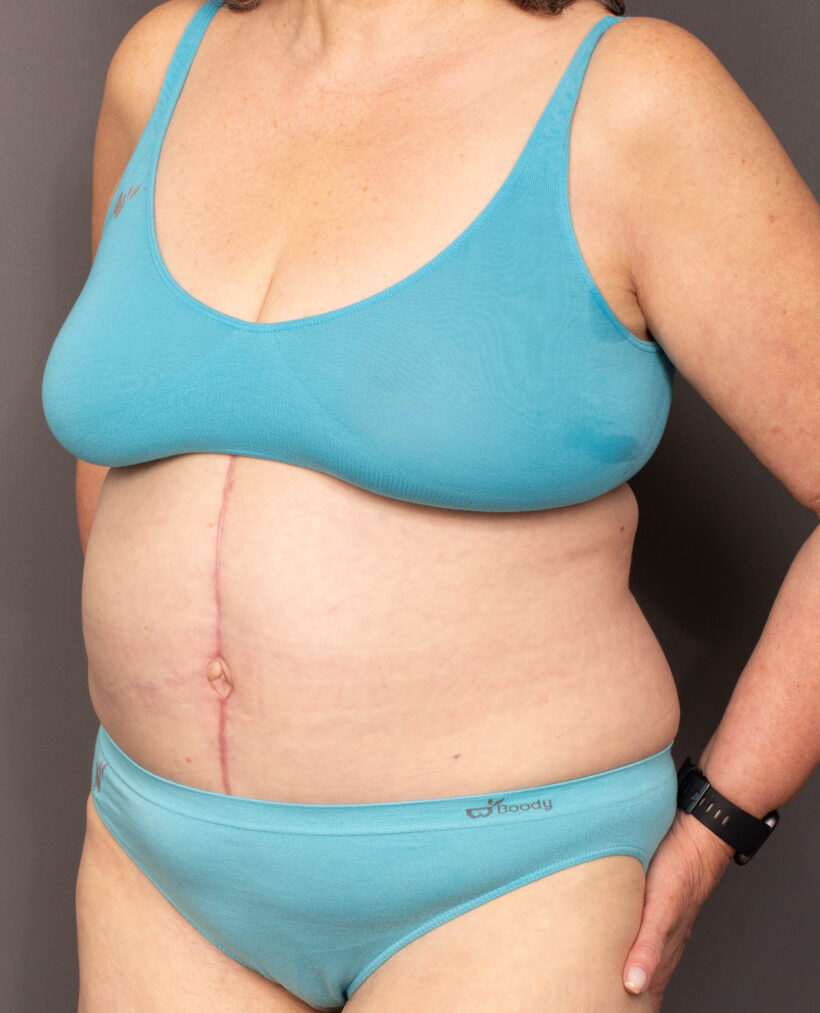 After Procedure