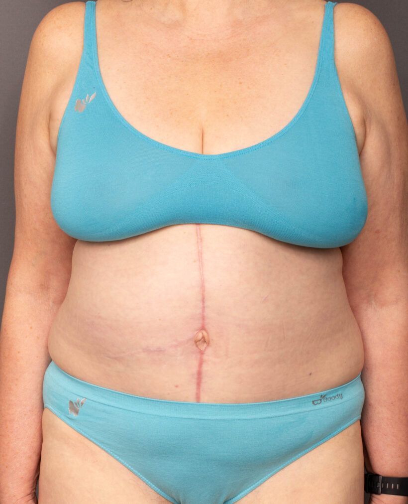 After Procedure