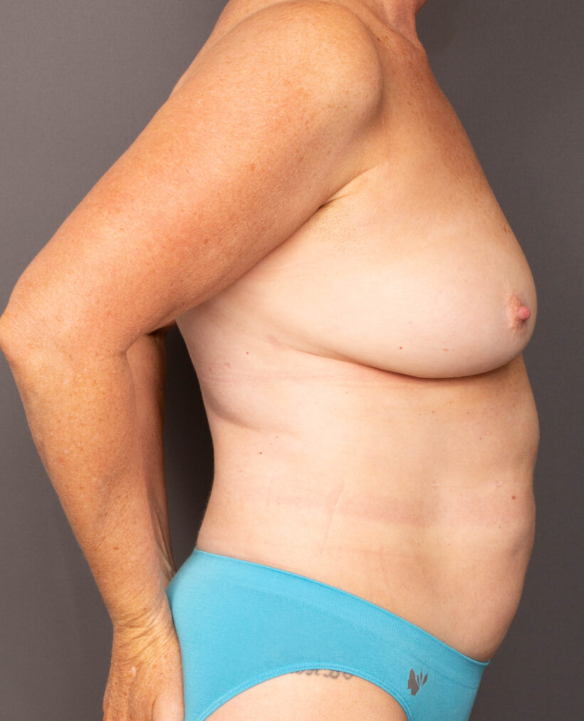After Procedure