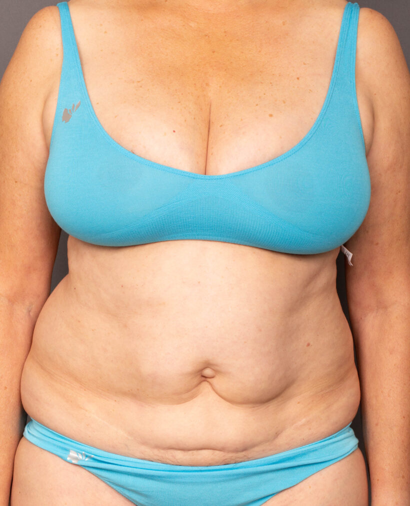 Before Procedure