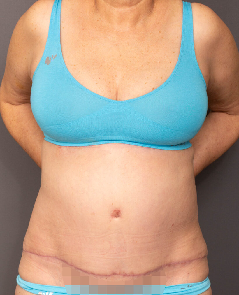 After Procedure