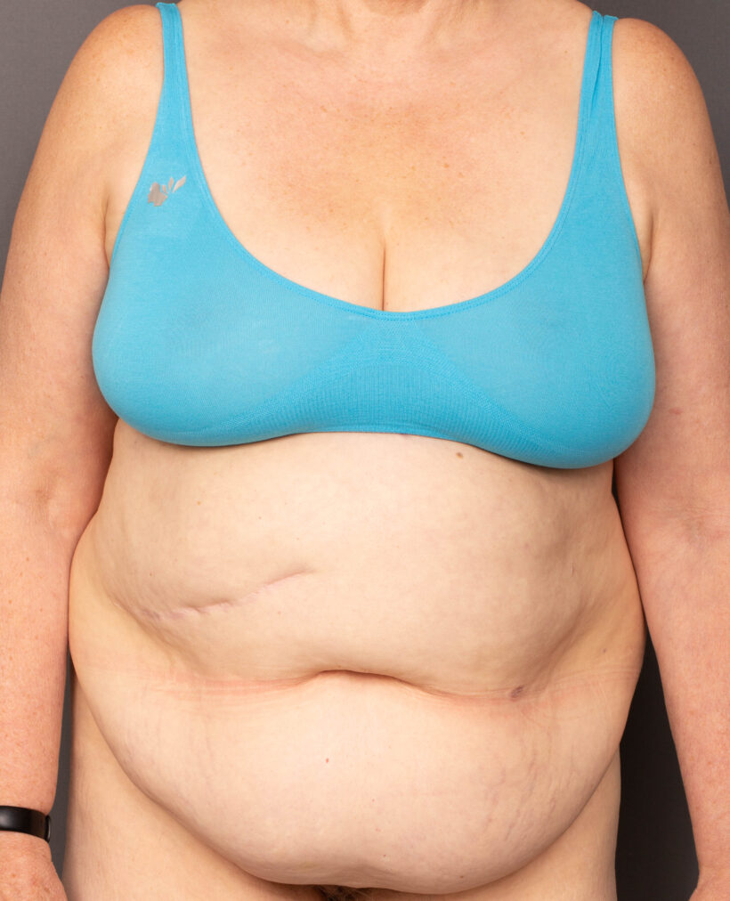 Before Procedure