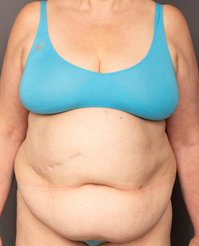 Before Procedure