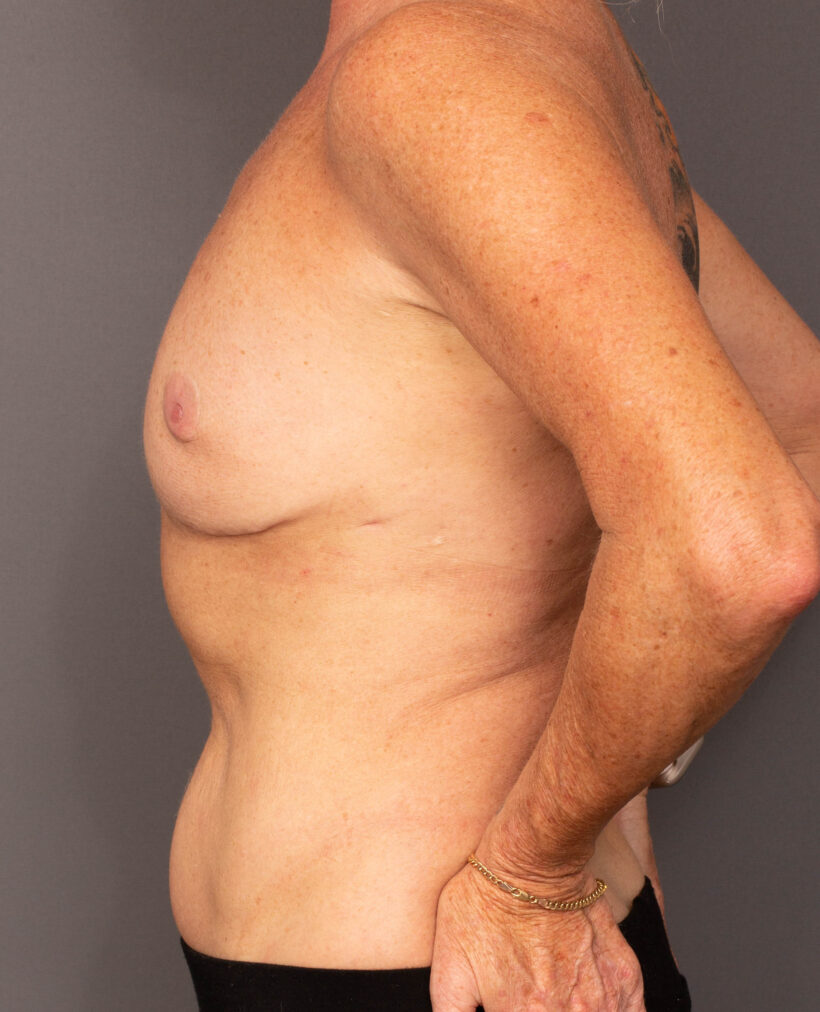 After Procedure