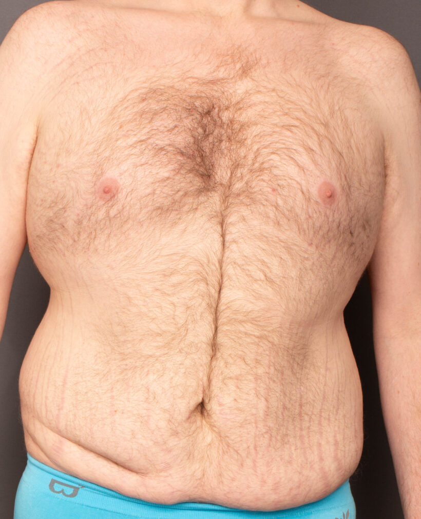 Before Procedure