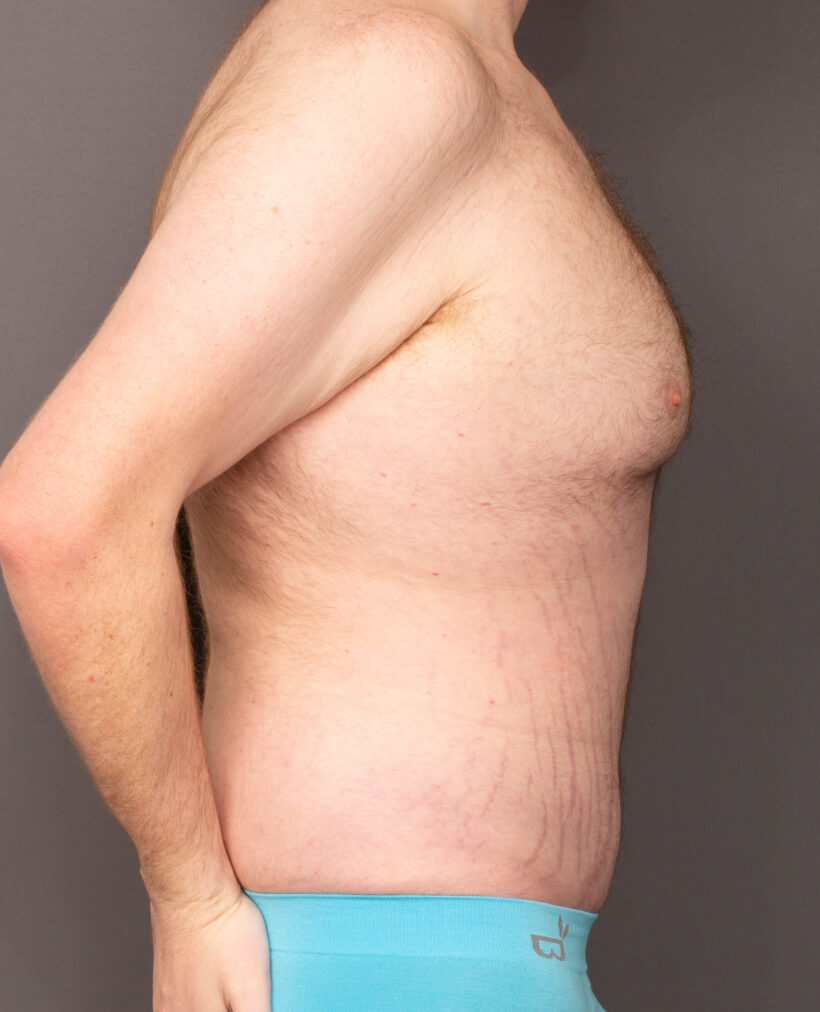 After Procedure