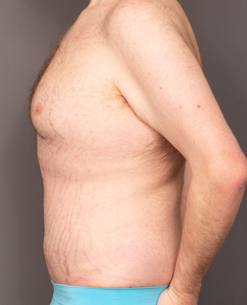 After Procedure