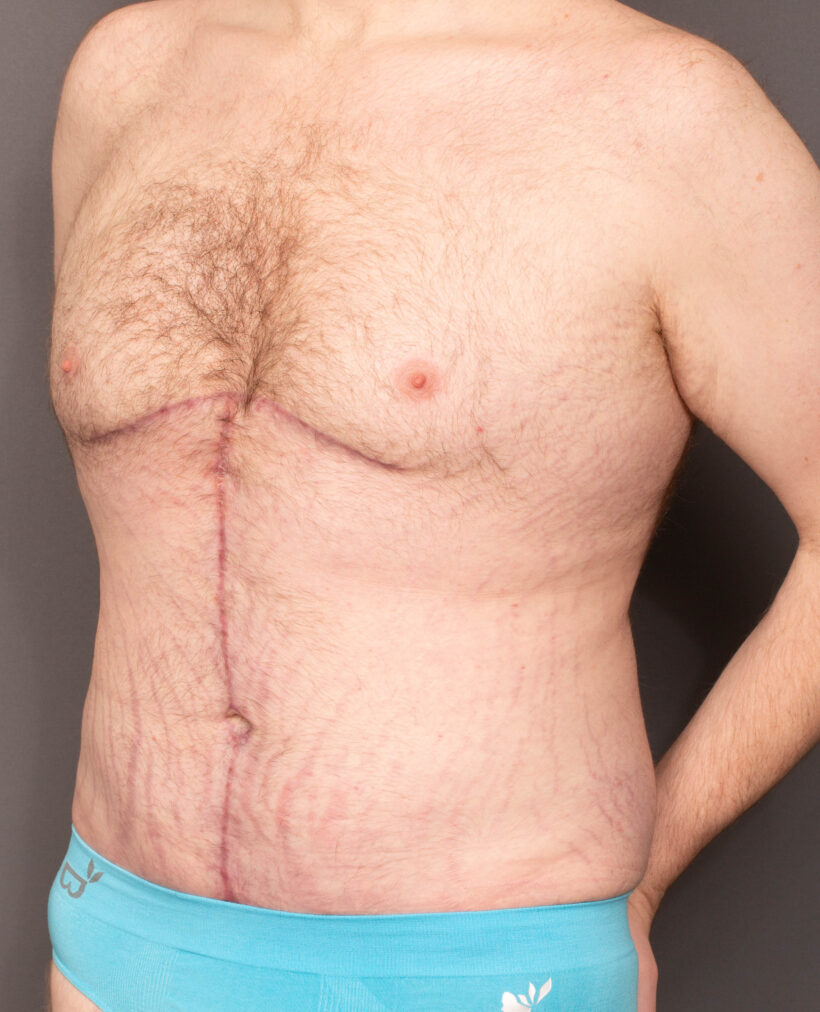 After Procedure
