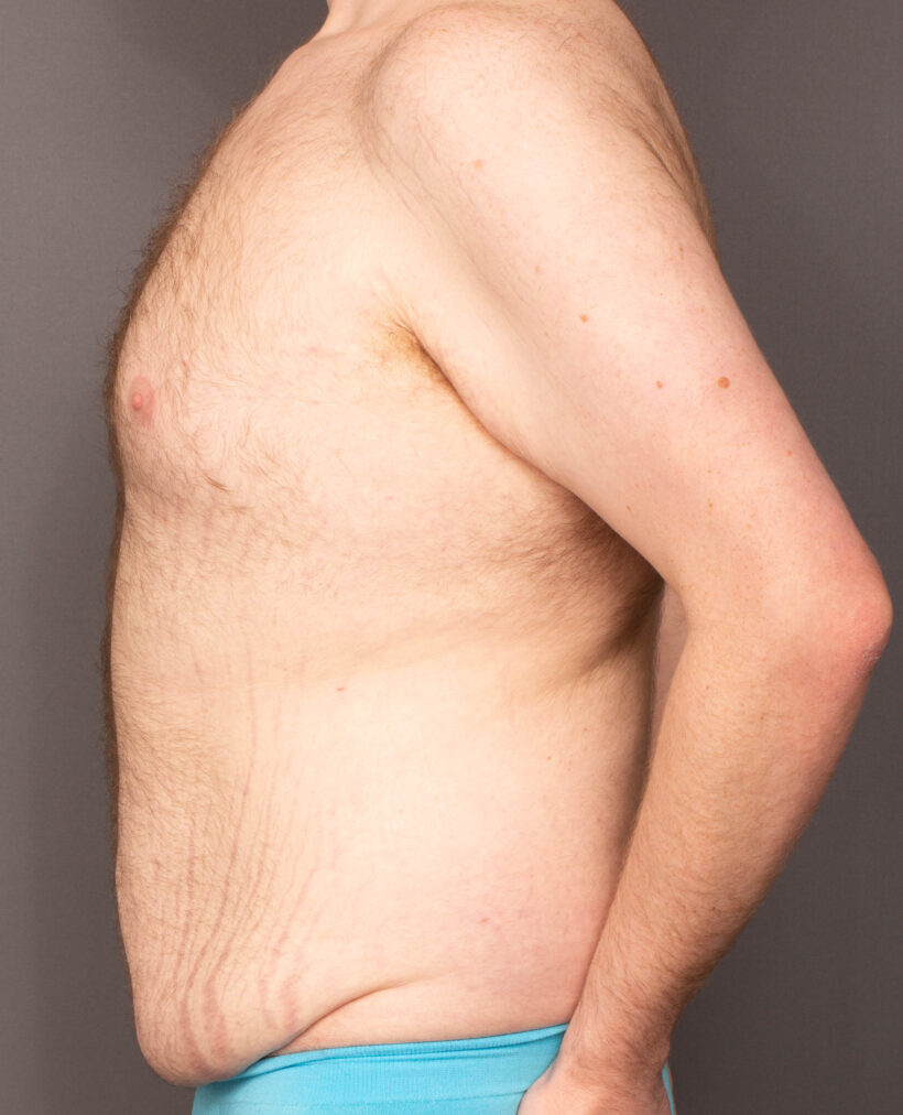 Before Procedure