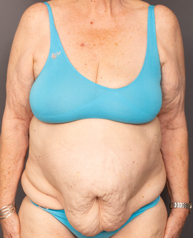 Before Procedure
