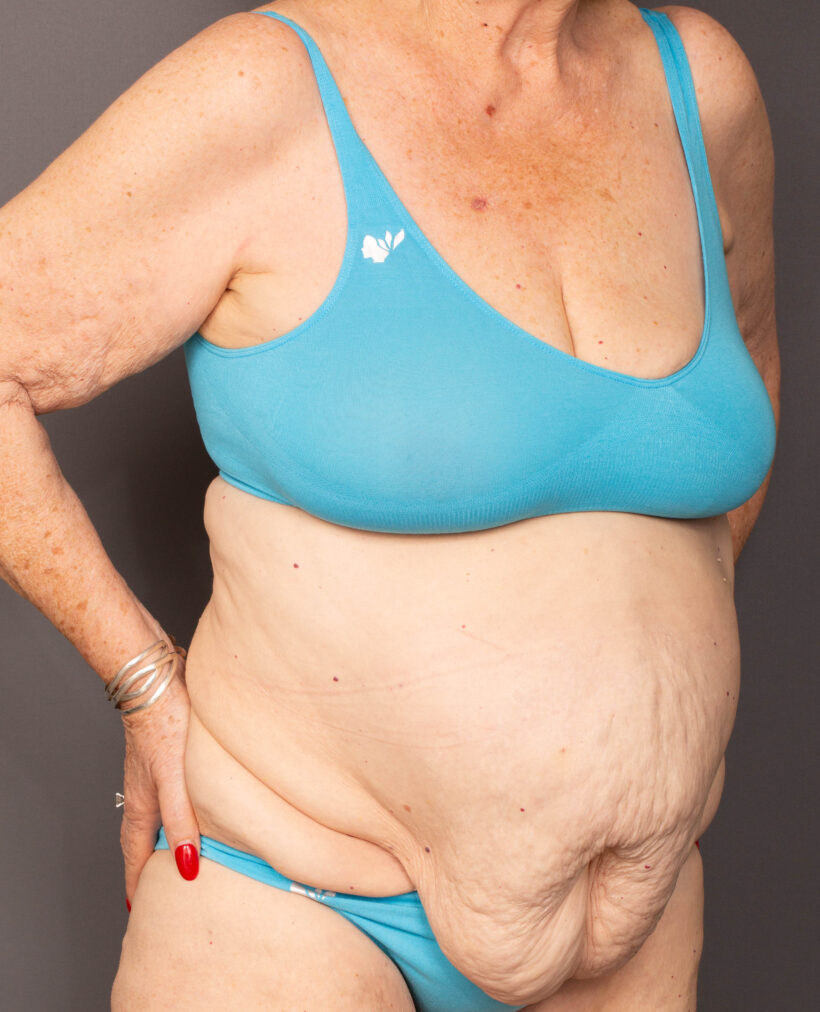 Before Procedure