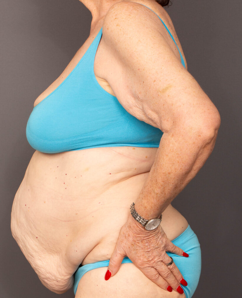 Before Procedure