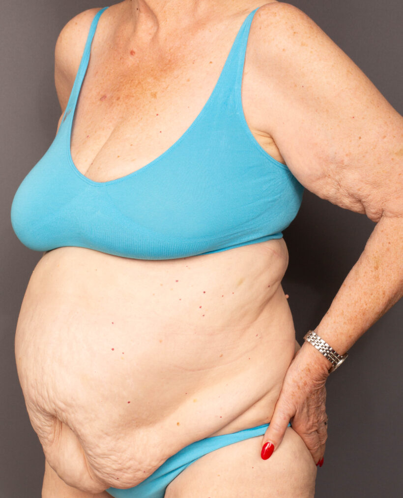 Before Procedure