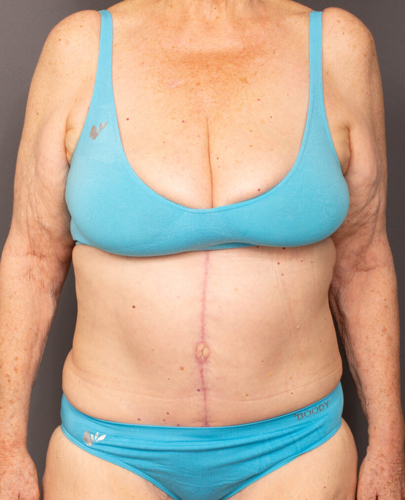 After Procedure
