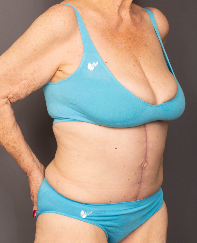 After Procedure