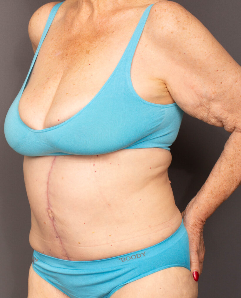 After Procedure