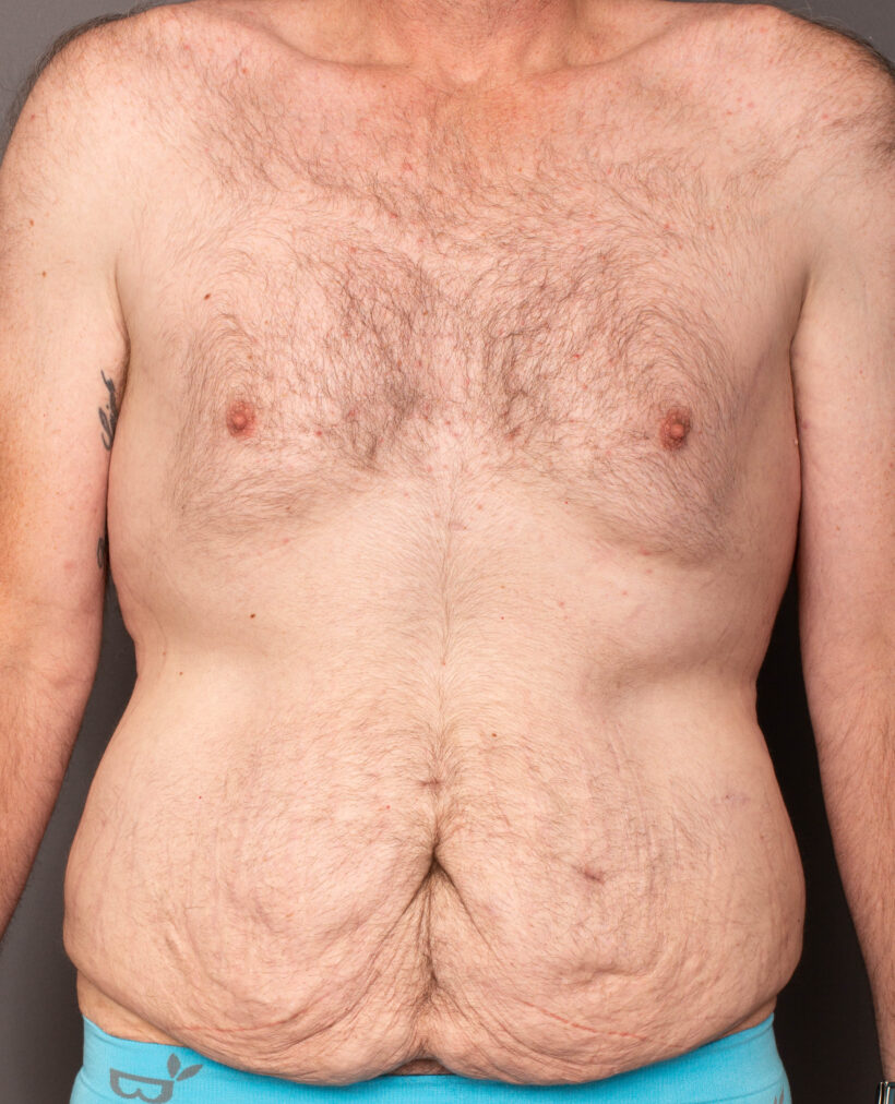 Before Procedure