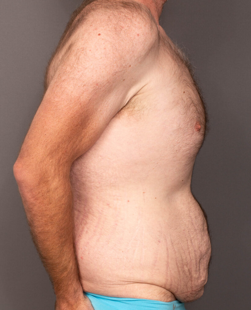 Before Procedure