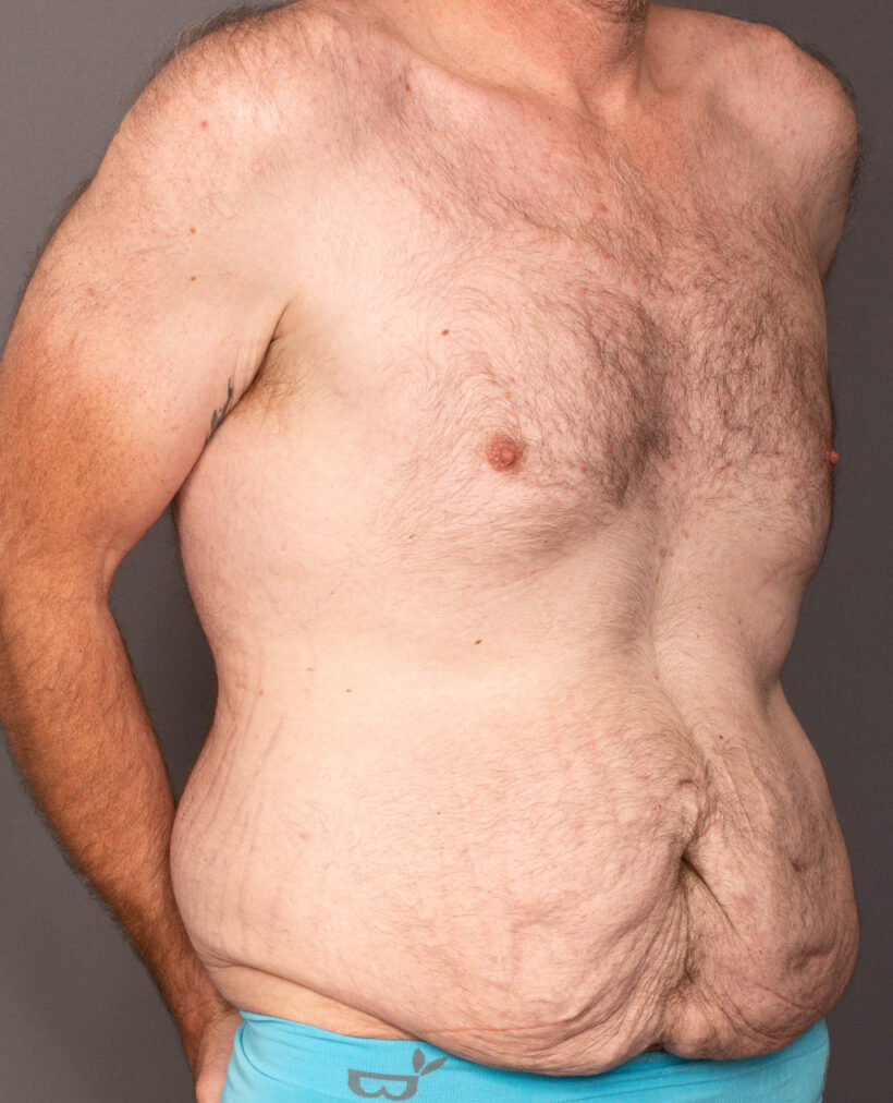 Before Procedure