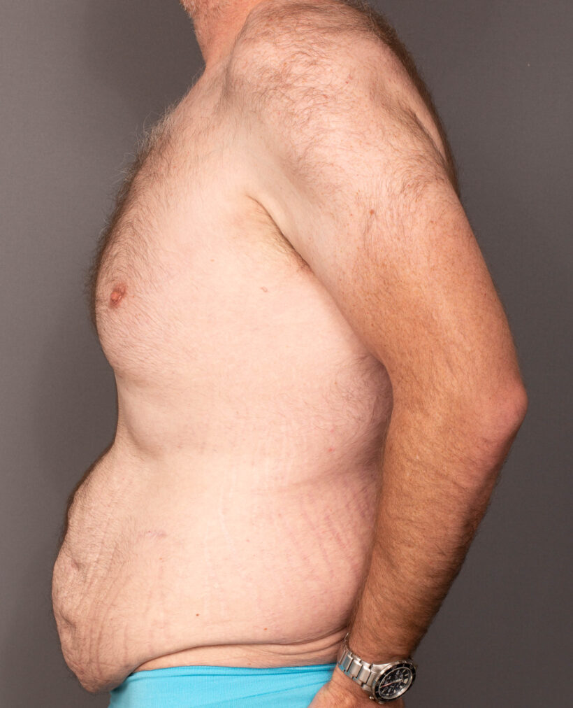 Before Procedure