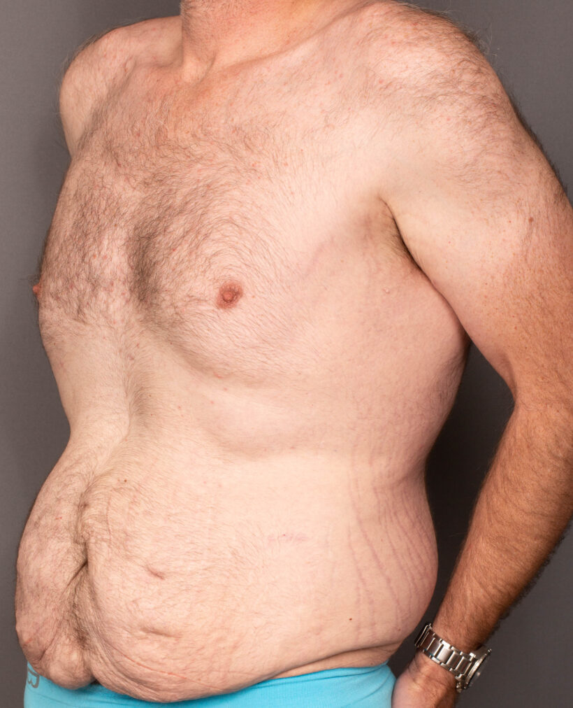 Before Procedure