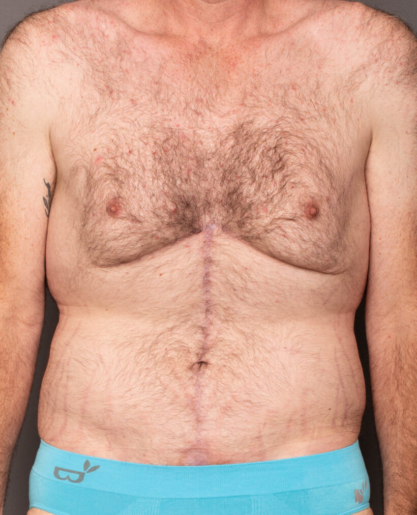After Procedure