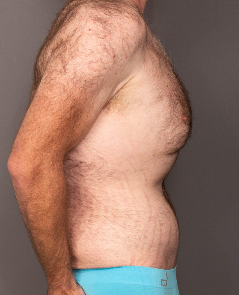 After Procedure