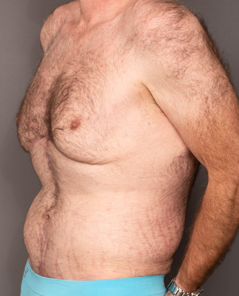 After Procedure