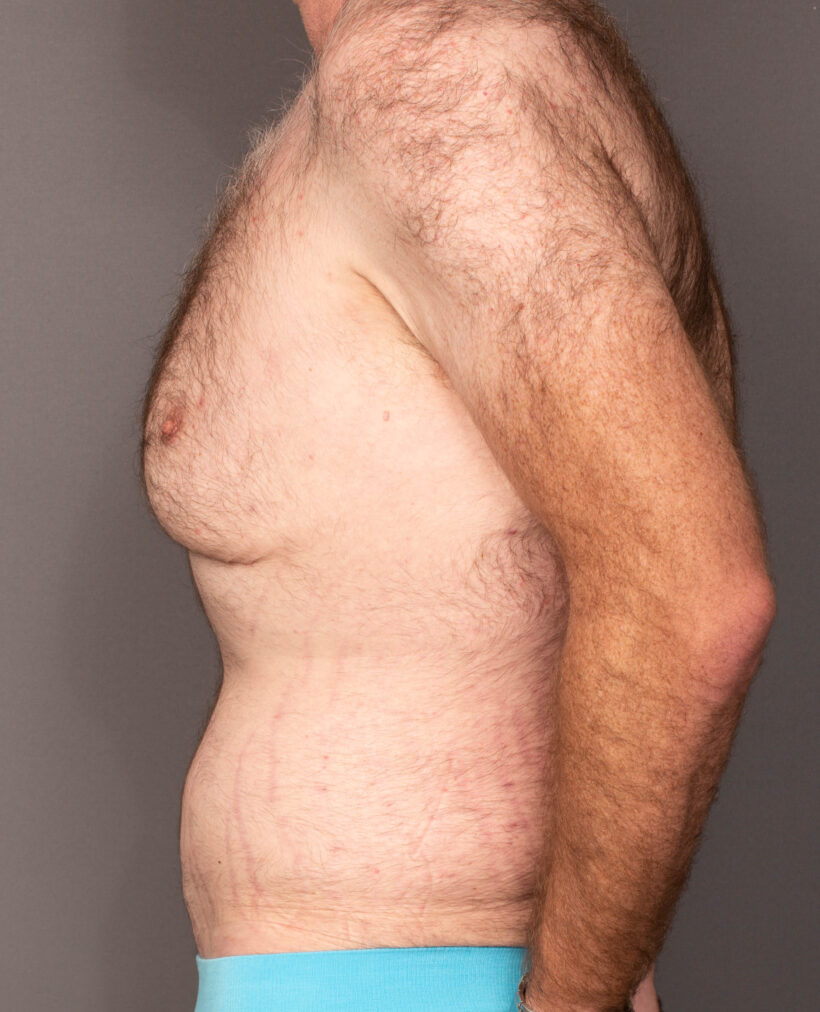 After Procedure