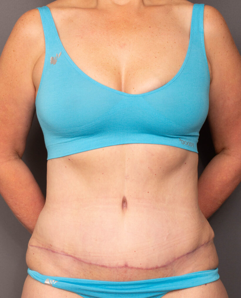 After Procedure